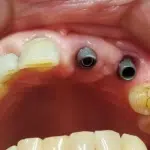 pernos implantes dentales